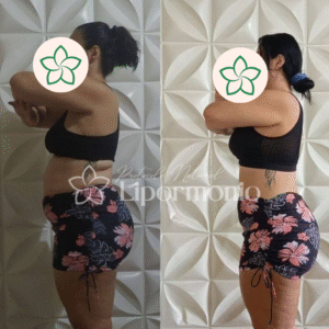 Antes&Depois_LipormonioNew (1)