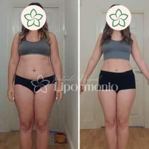 Antes&Depois_LipormonioNew (3)