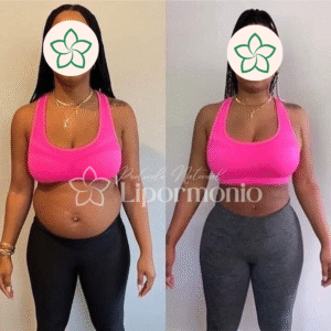 Antes&Depois_LipormonioNew (4)