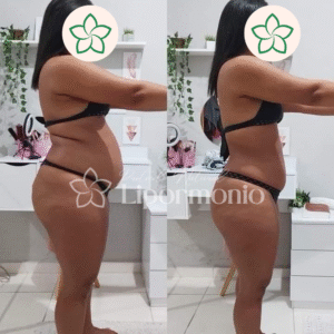 Antes&Depois_LipormonioNew (5)