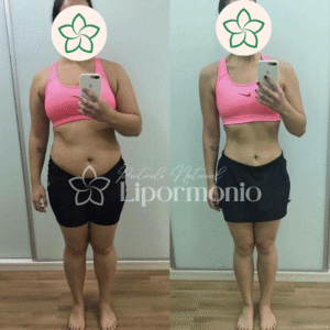 Antes&Depois_LipormonioNew (6)